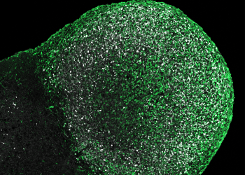 Los organoides cerebrales desvelan nuevas causas de la esclerosis tuberosa