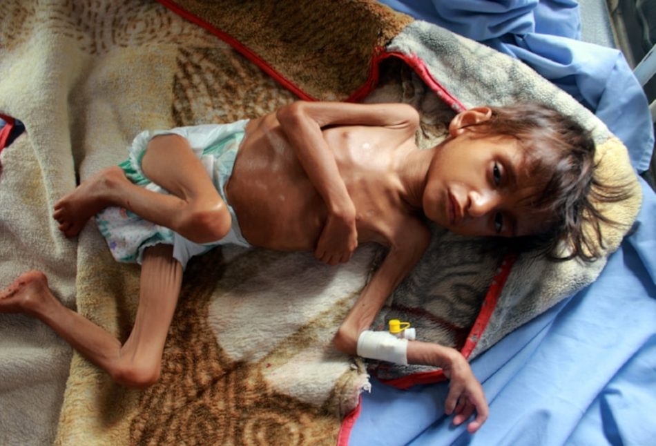 Desnutrición amenaza a 4,5 millones de niños yemenitas