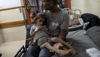 Desnutrición infantil en Gaza se disparó al 300 por ciento en julio